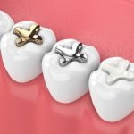 پرکردن دندان چیست ؟