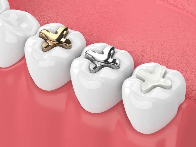 پرکردن دندان چیست ؟